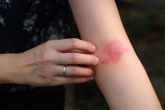When to Visit the Urgent Care for Skin Rashes and Reactions